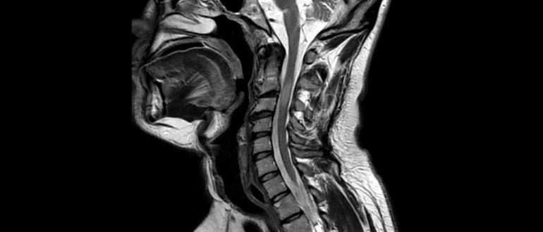 Объяснение результатов МРТ шейного отдела хребта