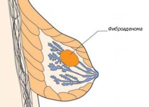 Фиброаденома и гормоны