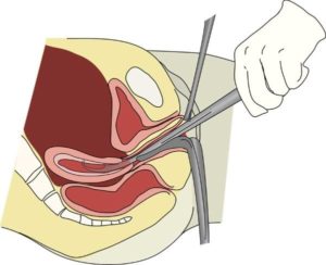 Гиперплазия эндометрия после выскабливания