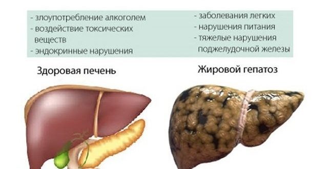 Горечь во рту при лечении панкреатита и жирового гепатоза