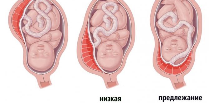 Низкая плацентация, ан. Тяж, беременность 31 неделя