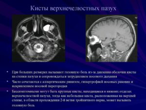 Головокружения от наличия Кисты верхнечелюстной пазухи - возможно ли это?