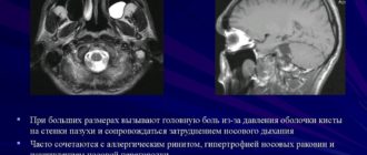 Головокружения от наличия Кисты верхнечелюстной пазухи - возможно ли это?