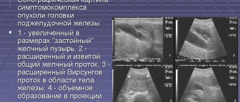 Объемное образование поджелудочной железы