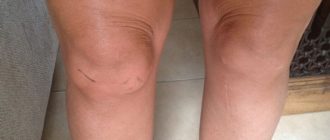 Опухло и отекает левое бедро сререди
