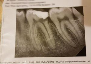 Ноет зуб причины, расшифровка рентген-снимка