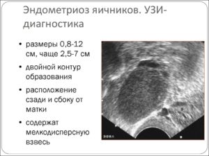 Диагноз эндометриоз по УЗИ