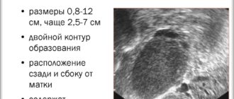 Диагноз эндометриоз по УЗИ