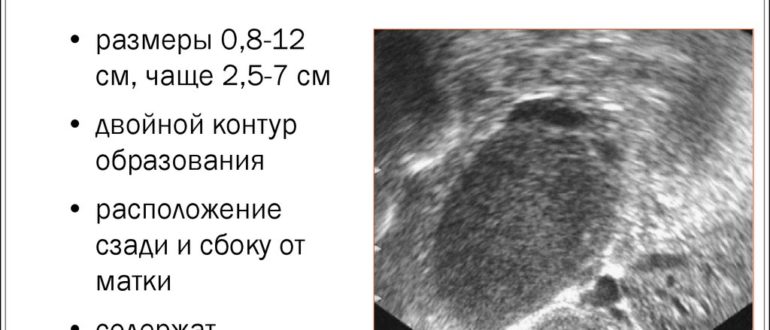 Диагноз эндометриоз по УЗИ