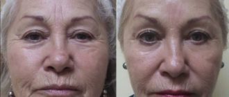 Осложнение после ксеомина