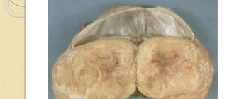 Фиброма яичника и онкомаркеры