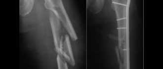 Оскольчатый перелом бедра