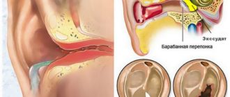 Острый посттравматический средний отит