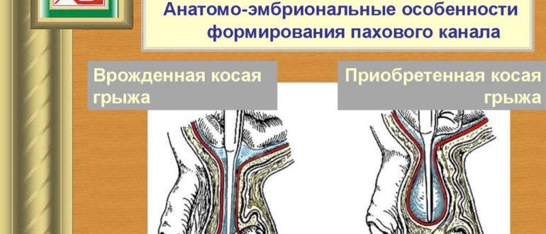 Паховые грыжи