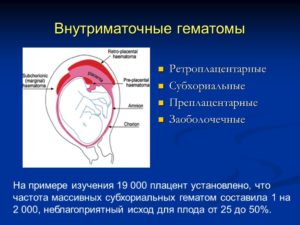 Гематома при беременности
