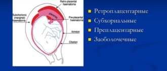 Гематома при беременности