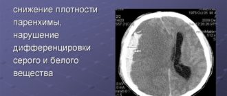 Отек головного мозга