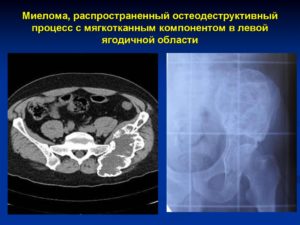 Нужна ли операция по результатам КТ. Пугает название мягкотканный компонент