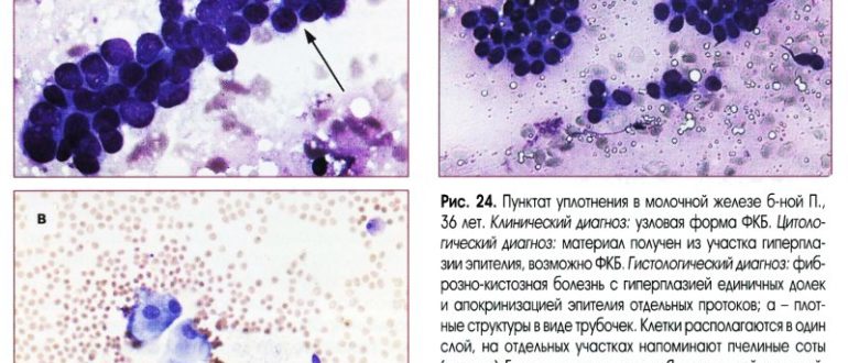 Фиброзо-кистозная мастопатия, диагноз по цитологии