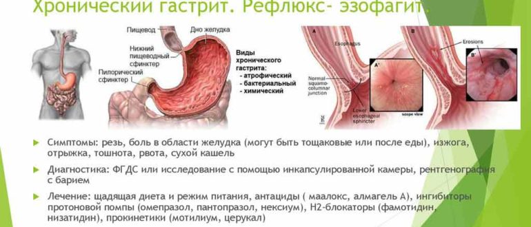 Гастрит, рефлюкс-эзофагит