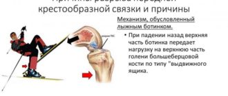 Парциальное првреждерие передней крестообразной связки