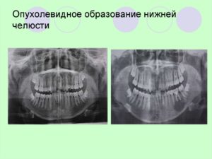 Образование на нижней челюсти