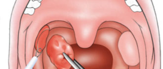 Опухоль под гландой