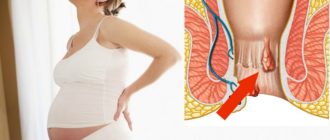 Геморрой, беременность 31 неделя