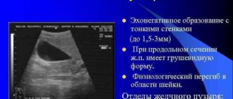 Перегиб желчного пузыря, гомогенная полость