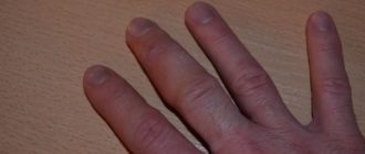 Опух и болит палец без причины