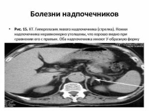 Гиперплазия латеральной ножки левого надпочечника