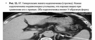 Гиперплазия латеральной ножки левого надпочечника