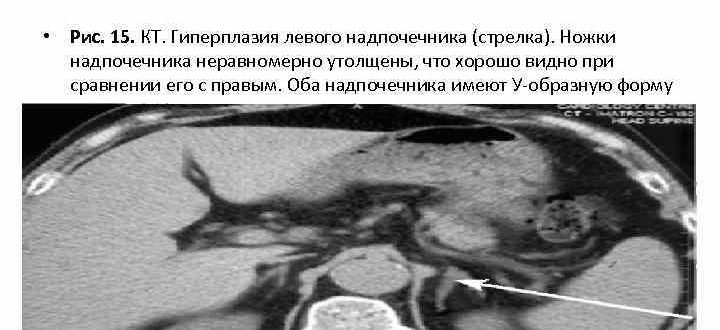 Гиперплазия латеральной ножки левого надпочечника