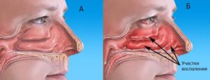 Нечто вроде воспаления в носу
