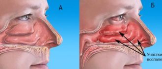 Нечто вроде воспаления в носу