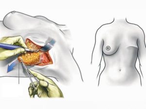 Необходи ли срочная операция по удалению груди?