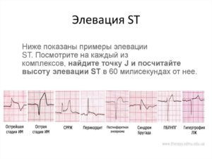 Неспецифиеские нарушения st-t (элевация)