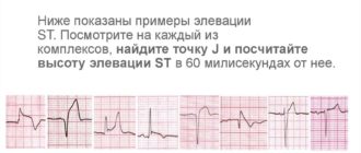 Неспецифиеские нарушения st-t (элевация)