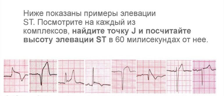 Неспецифиеские нарушения st-t (элевация)