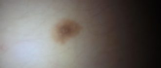 Небольшой бугорок на голове с коричневым ореолом вокруг