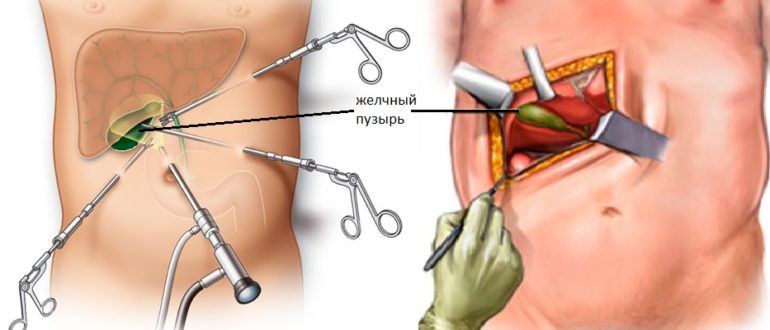 Гепапротектор после удаления желчного пузыря№