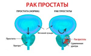 Остановка кровотечения из простаты. Лечение рака простаты