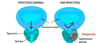 Остановка кровотечения из простаты. Лечение рака простаты