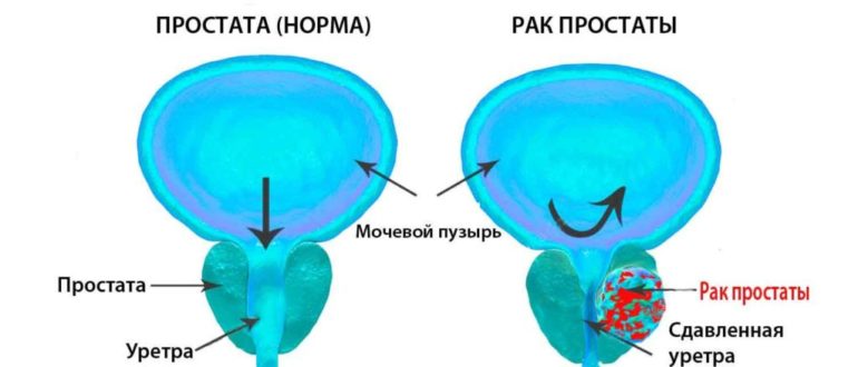 Остановка кровотечения из простаты. Лечение рака простаты