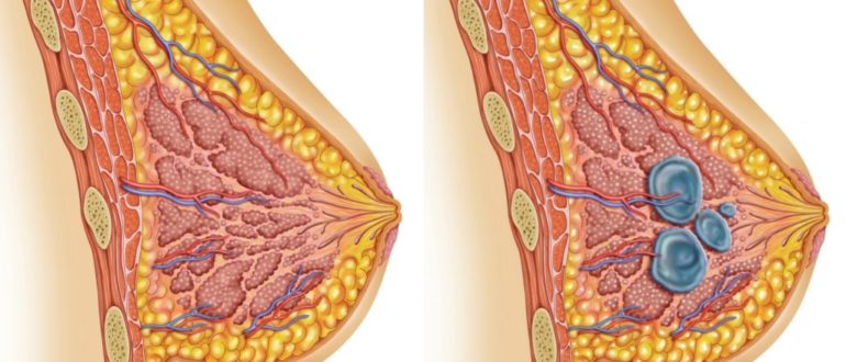 Фиброзно-кистозная мастопатия (единичная киста)