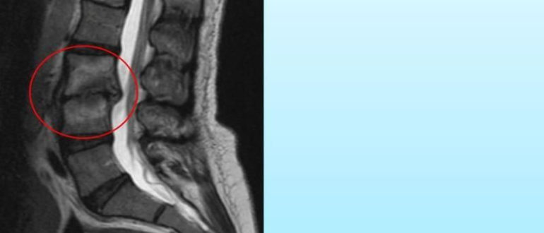 Опасен ли реактивный псевдовоспалительный отек костного мозга позвоночника