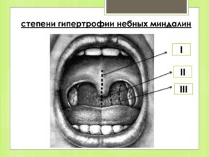 Гипертрофия миндалин 3 степени и подрезание