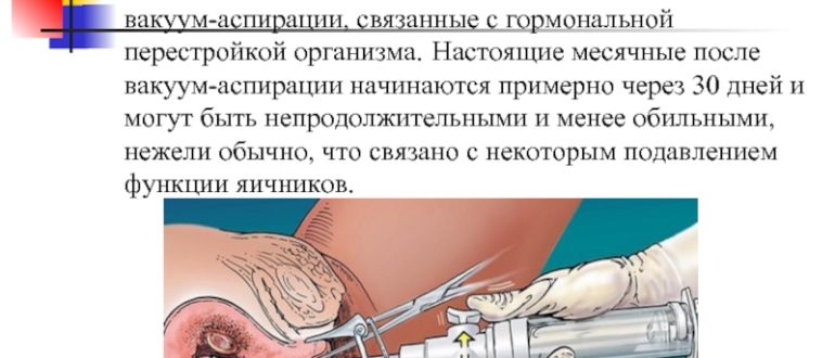 Нет месячных после вакуума