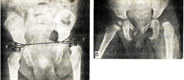Незрелость тазобедренных суставов у новорожденных. Ядра окостенения тазобедренных суставов в 4 мес. Ядра окостенения бедренной кости. Дисплазия тазобедренных суставов с задержкой. Окостенение тазобедренных суставов.