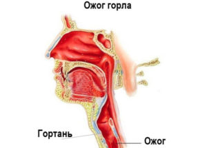 Отек горла и носоглотки